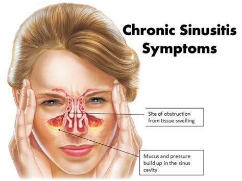 lightheaded sinus infection